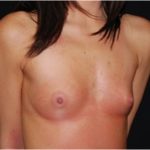 Breast Augmentation - Round Silicone Implants Before & After Patient #26286