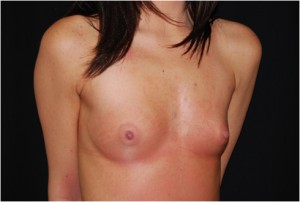 Breast Augmentation - Round Silicone Implants Before & After Patient #26286