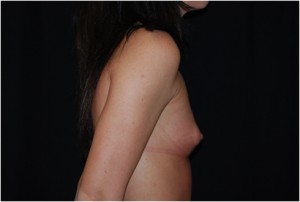 Breast Augmentation - Round Silicone Implants Before & After Patient #26286