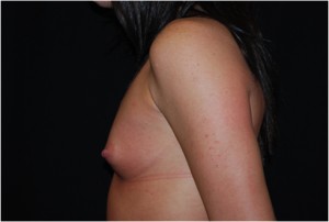 Breast Augmentation - Round Silicone Implants Before & After Patient #26286