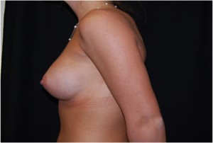 Breast Augmentation - Round Silicone Implants Before & After Patient #26286