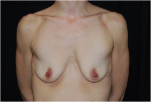 Breast Augmentation - Round Silicone Implants Before & After Patient #25913