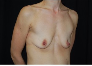 Breast Augmentation - Round Silicone Implants Before & After Patient #25913