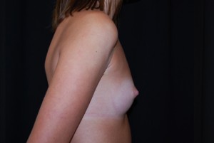 Breast Augmentation - Round Silicone Implants Before & After Patient #26295