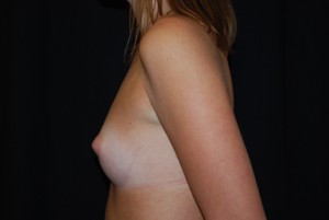 Breast Augmentation - Round Silicone Implants Before & After Patient #26295