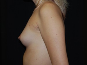 Breast Augmentation - Round Silicone Implants Before & After Patient #25597