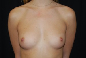 Breast Augmentation - Round Silicone Implants Before & After Patient #26306
