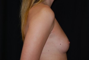 Breast Augmentation - Round Silicone Implants Before & After Patient #26306