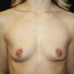 Breast Augmentation - Round Silicone Implants Before & After Patient #25935