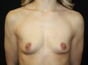 Breast Augmentation - Round Silicone Implants Before & After Patient #25935