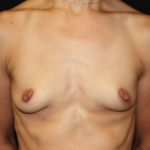 Breast Augmentation - Round Silicone Implants Before & After Patient #25946