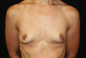 Breast Augmentation - Round Silicone Implants Before & After Patient #25946