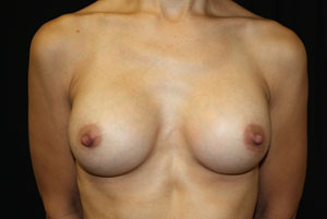 Breast Augmentation - Round Silicone Implants Before & After Patient #25946