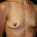 Breast Augmentation - Round Silicone Implants Before & After Patient #25946