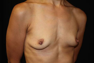 Breast Augmentation - Round Silicone Implants Before & After Patient #25946