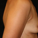 Breast Augmentation - Round Silicone Implants Before & After Patient #25946