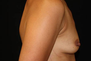 Breast Augmentation - Round Silicone Implants Before & After Patient #25946