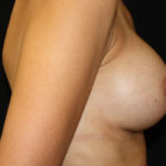 Breast Augmentation - Round Silicone Implants Before & After Patient #25946