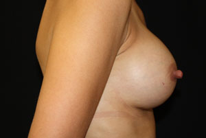 Breast Augmentation - Round Silicone Implants Before & After Patient #25946