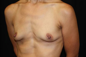 Breast Augmentation - Round Silicone Implants Before & After Patient #25946