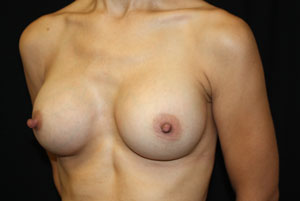 Breast Augmentation - Round Silicone Implants Before & After Patient #25946