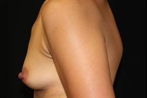 Breast Augmentation - Round Silicone Implants Before & After Patient #25946