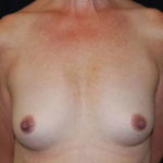 Breast Augmentation - Round Silicone Implants Before & After Patient #25957