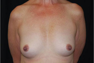 Breast Augmentation - Round Silicone Implants Before & After Patient #25957