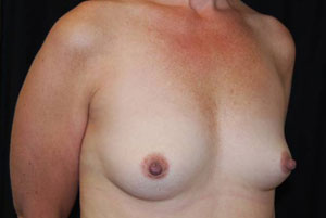 Breast Augmentation - Round Silicone Implants Before & After Patient #25957