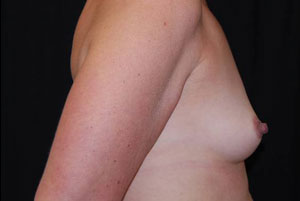 Breast Augmentation - Round Silicone Implants Before & After Patient #25957