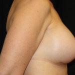 Breast Augmentation - Round Silicone Implants Before & After Patient #25957