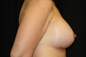 Breast Augmentation - Round Silicone Implants Before & After Patient #25957