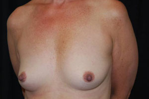 Breast Augmentation - Round Silicone Implants Before & After Patient #25957