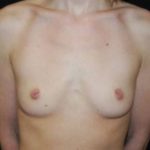 Breast Augmentation - Round Silicone Implants Before & After Patient #26328