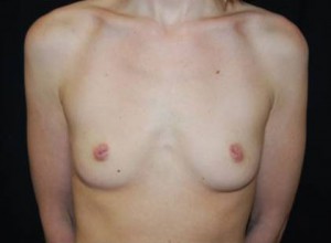 Breast Augmentation - Round Silicone Implants Before & After Patient #26328