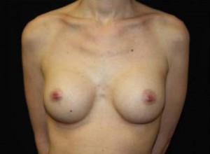 Breast Augmentation - Round Silicone Implants Before & After Patient #26328