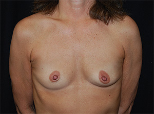 Breast Augmentation - Round Silicone Implants Before & After Patient #25535