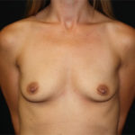 Breast Augmentation - Round Silicone Implants Before & After Patient #25968