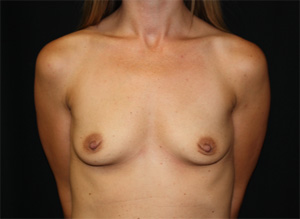 Breast Augmentation - Round Silicone Implants Before & After Patient #25968