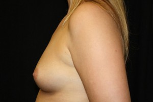 Breast Augmentation - Round Silicone Implants Before & After Patient #25979
