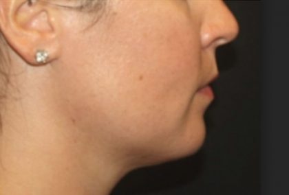 Kybella Before & After Patient #25350