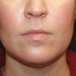 Kybella Before & After Patient #25350