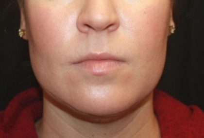 Kybella Before & After Patient #25350