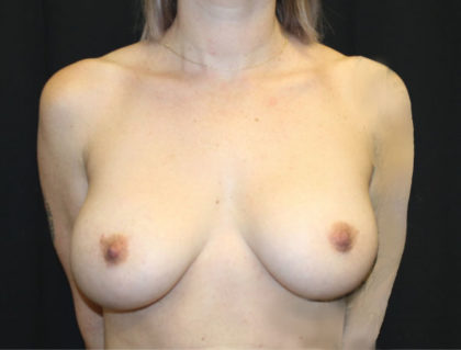 Breast Implant Exchange Before & After Patient #26549