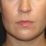 Kybella Before & After Patient #25350