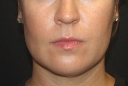 Kybella Before & After Patient #25350