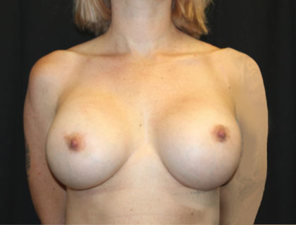 Breast Implant Exchange Before & After Patient #26549