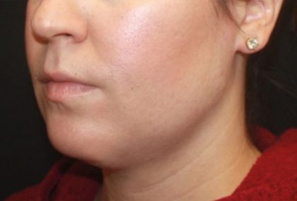 Kybella Before & After Patient #25350