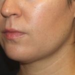 Kybella Before & After Patient #25350