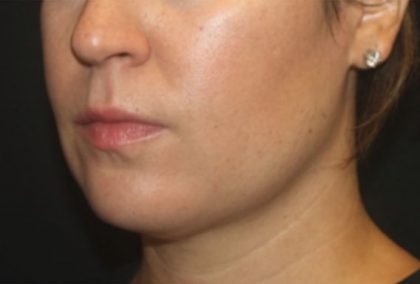 Kybella Before & After Patient #25350